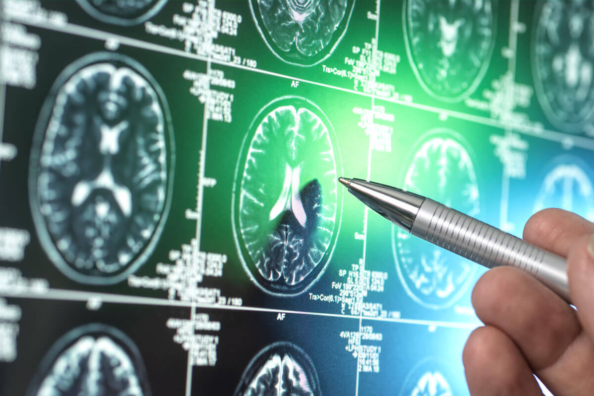  In MRT-Aufnahmen des Gehirns kann man bei Alzheimer-Demenz meist einen generellen Verlust der Hirnsubstanz erkennen. 