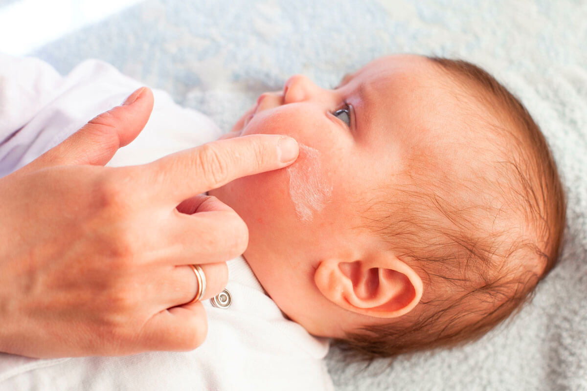  Bei Säuglingen mit Neurodermitis braucht man in der Woche bis zu 100 g Pflegecreme.