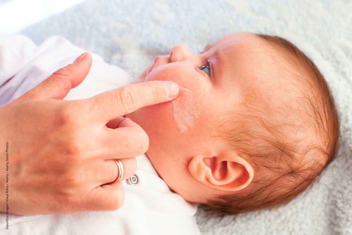Neurodermitis bei Kindern lindern