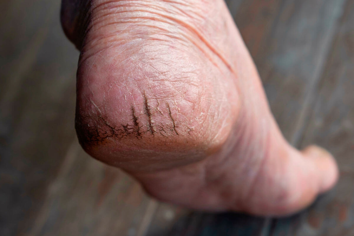 Rhagaden einfach zukleben