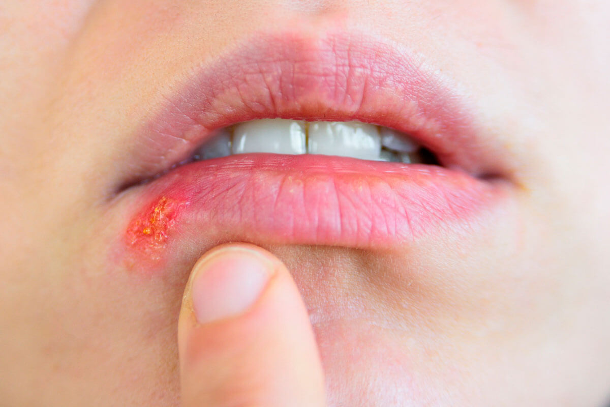 Wann Herpes gefährlich wird, © mauritius images / Tatyana Aksenova / Alamy / Alamy Stock Photos