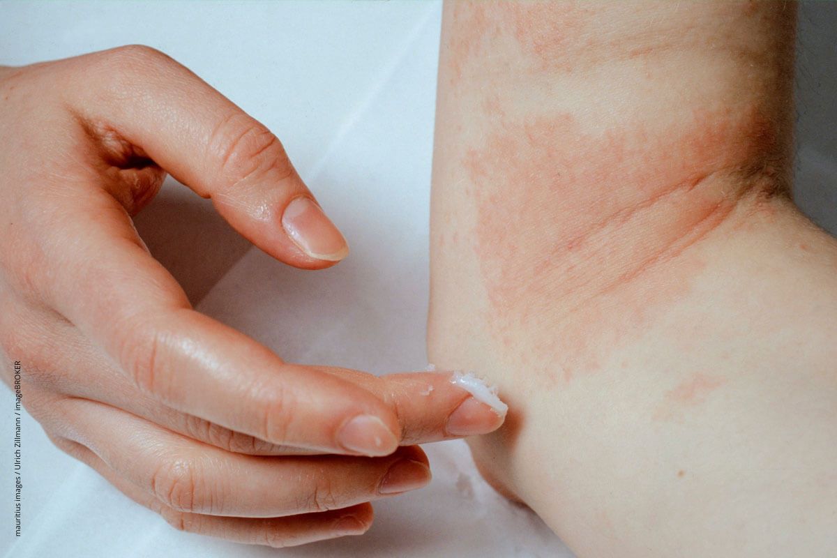Wieviel Urea ist gesund für die Haut?