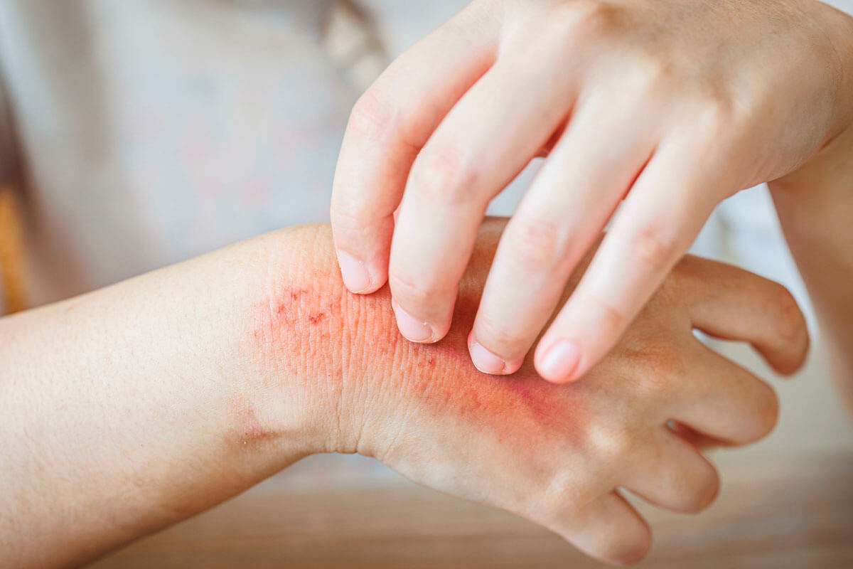 Neue Creme gegen Jucken und Schmerz