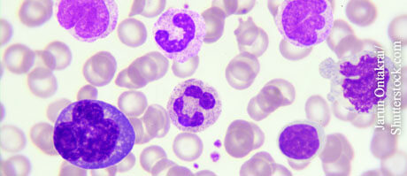 Eine HIV-Infektion schwächt bestimmte Zellen des Immunsystems, die zu den weißen Blutkörperchen gehören. Eine HIV-Infektion schwächt bestimmte Zellen des Immunsystems, die zu den weißen Blutkörperchen gehören.