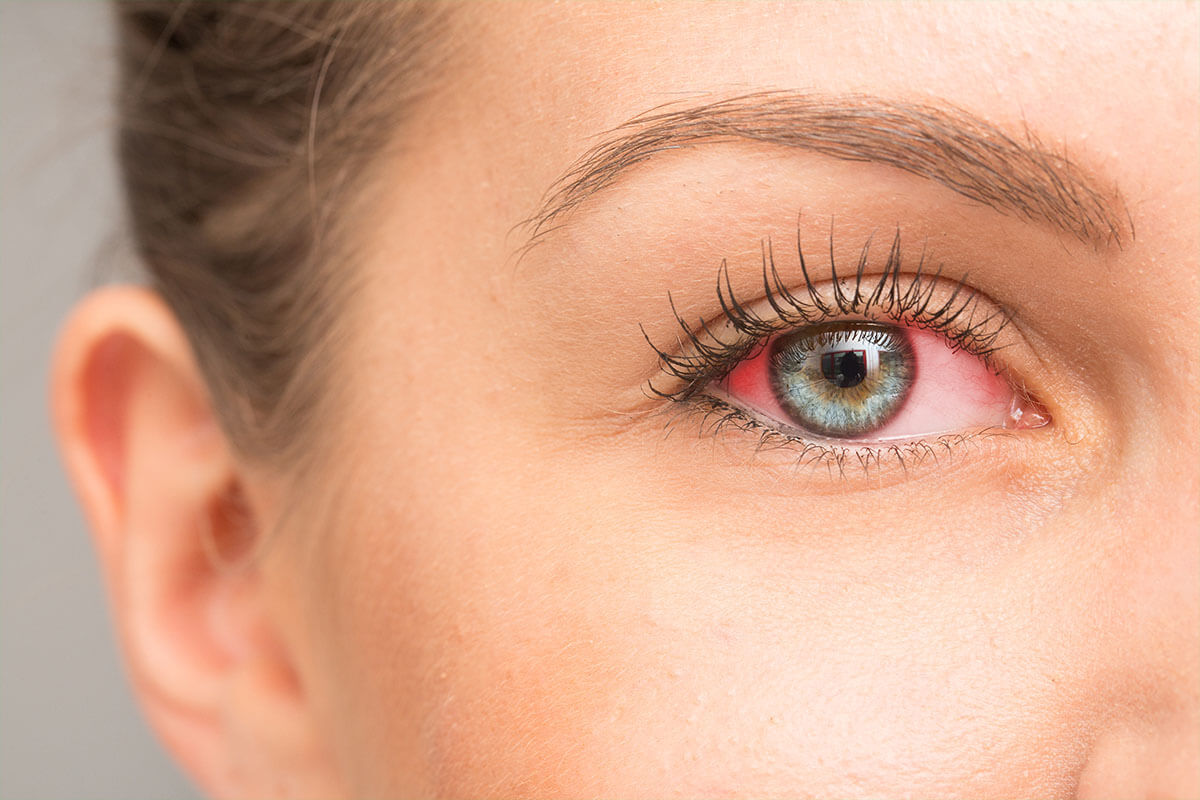 Rotes Auge, © sruilk/shutterstock.com